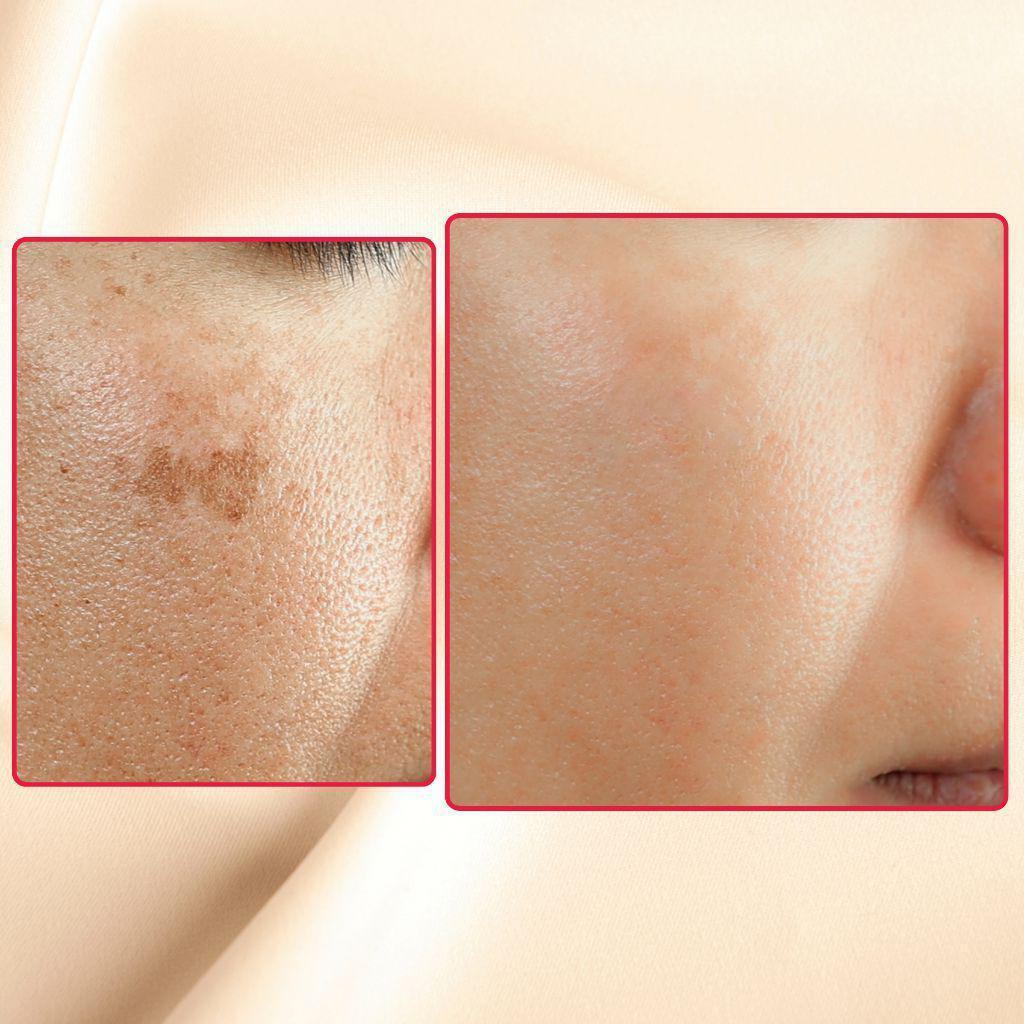 Gymsegbë - The Eraser Spot Cream | Dark Spot Remover