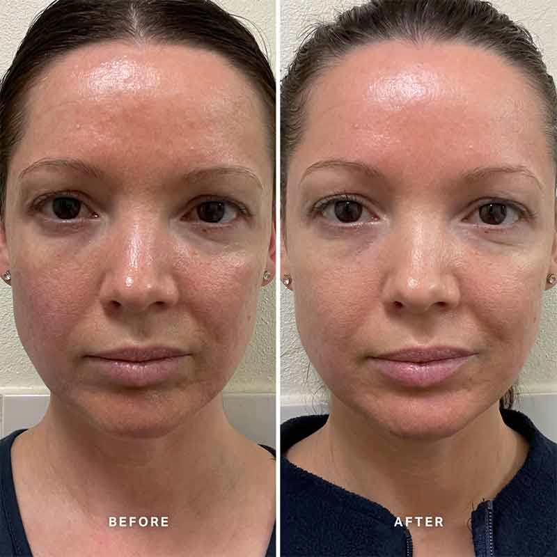 Alpha-H Vitamin B Serum with 5% Niacinamide